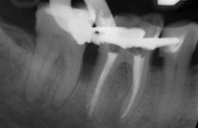Endodoncja INGLOT